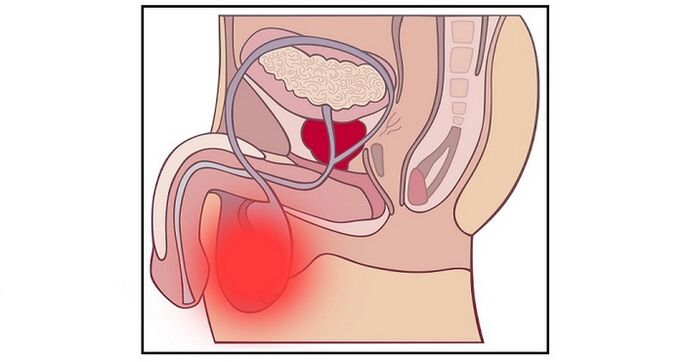 Unha complicación da cirurxía de ampliación do pene pode ser a inflamación dos testículos. 